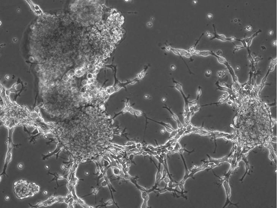 Tumor Infiltrating Lymphocytes (TIL) for Patients with Gliomas